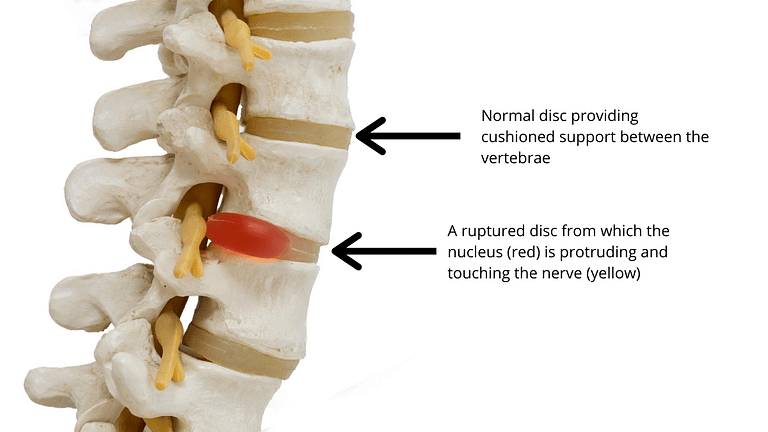 Herniated Disc (Slipped Disc) – What is it, Symptoms and Remedies ...